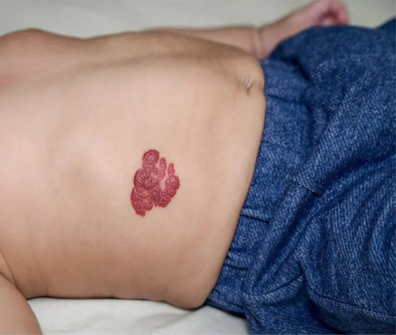 Bao Lâu Thì Bướu Máu Tự Hết? 1 buou mau 02