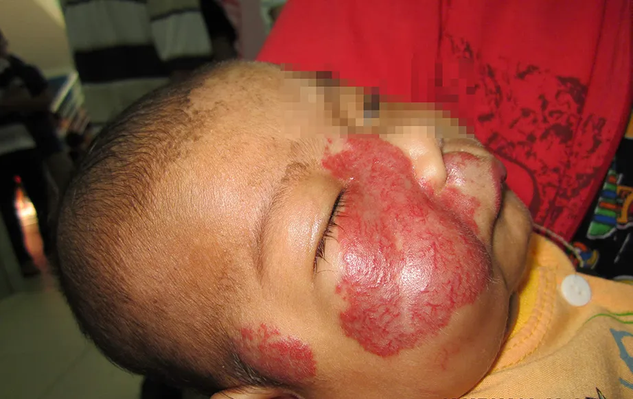 buou mau phat trien nhanh can kiem soat som 1