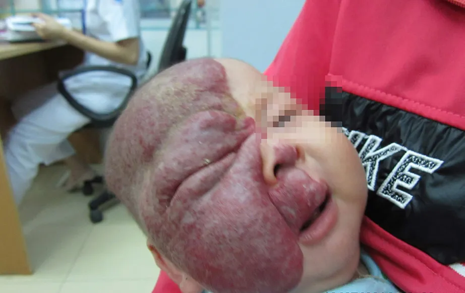 buou mau phat trien nhanh can kiem soat som 2