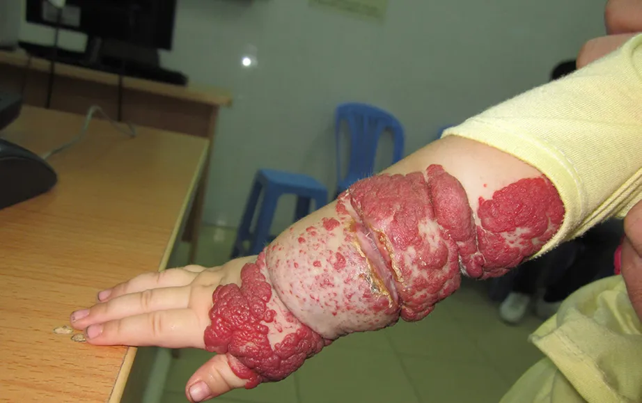 buou mau phat trien nhanh can kiem soat som 3