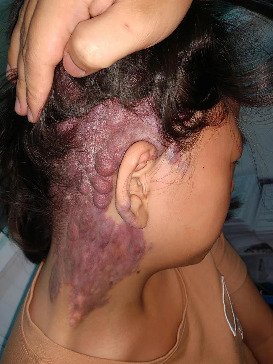 buou mau phat trien nhanh can kiem soat som 4