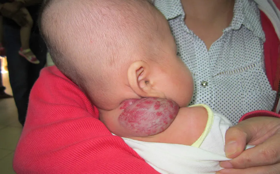 buou mau phat trien nhanh can kiem soat som 5