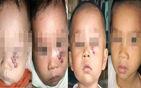 dieu tri buou mau 02